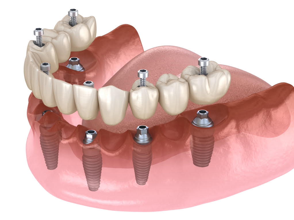 all on four e all on six implantologia dentale