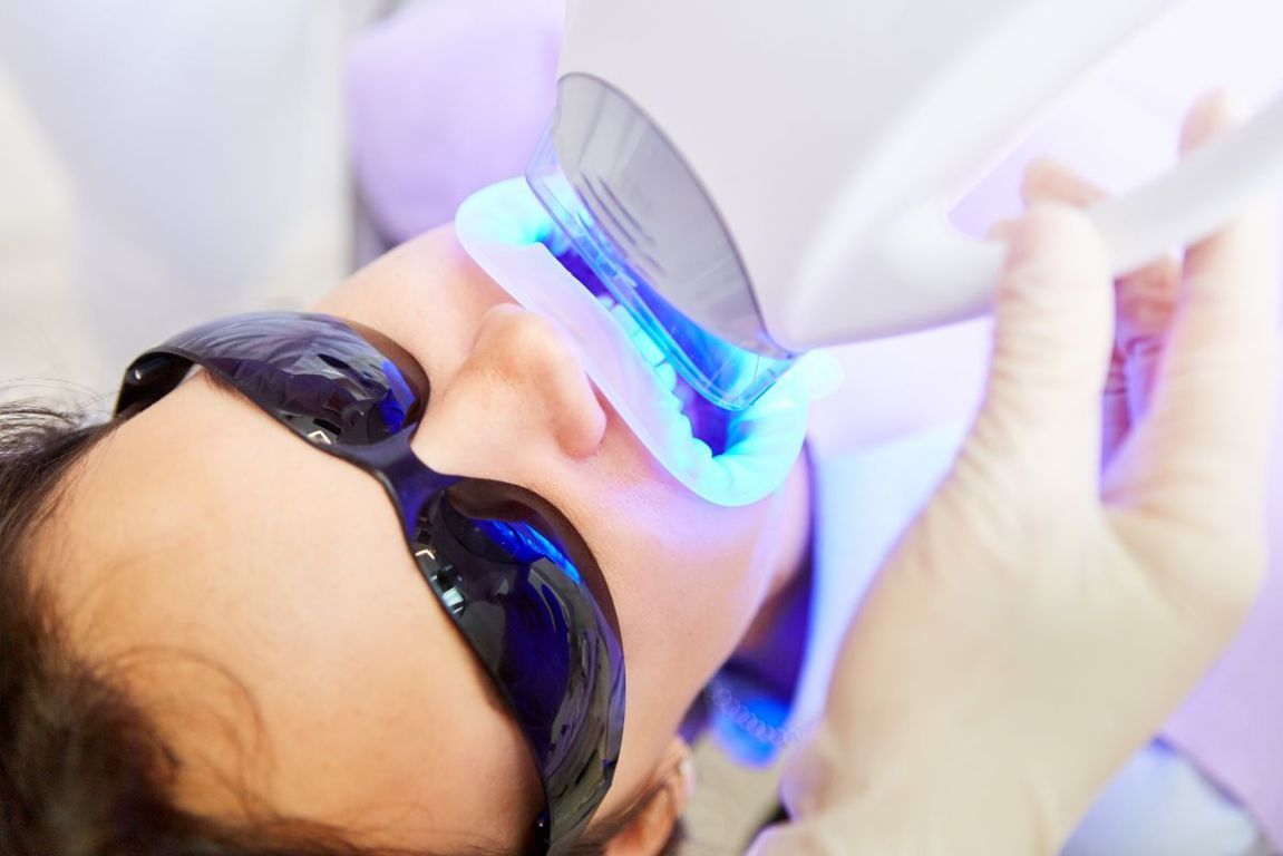 sbiancamento led controindicazioni