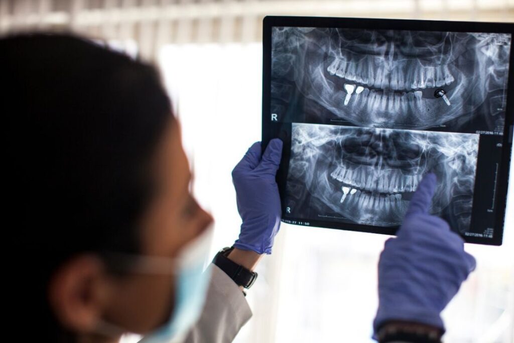 perimplantite