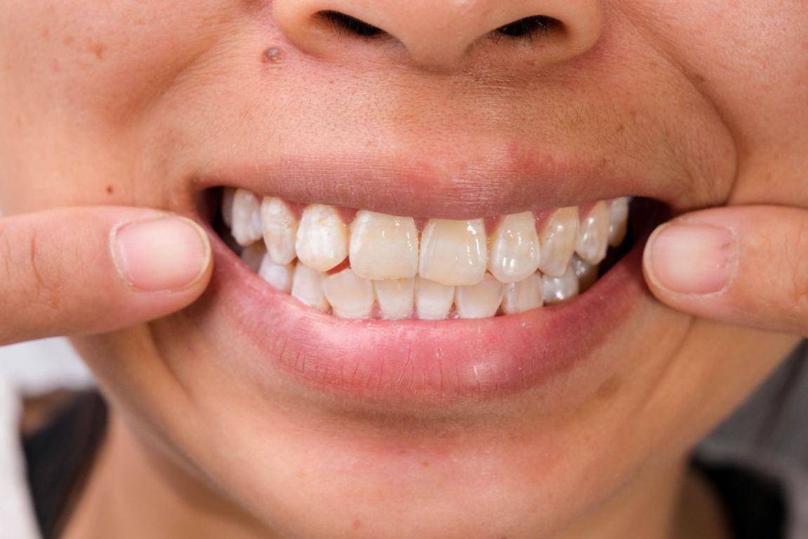 Macchie Bianche Sui Denti: A Cosa Sono Dovute? - Studio Dentistico San ...