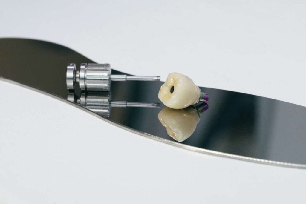 Cosa fare dopo inserimento di impianto dentale